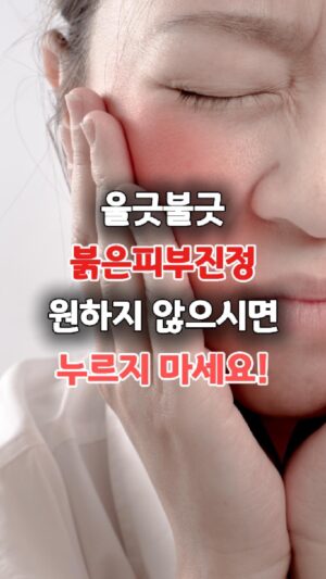붉은피부진정